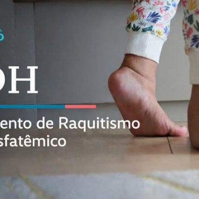 CDH debater tratamento do raquitismo no SUS ao vivo