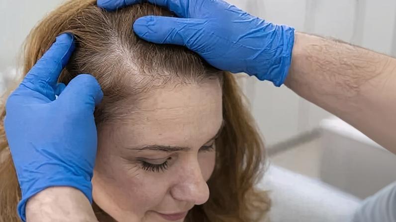 Procedimentos de transplante capilar em mulheres nem sempre surtem os efeitos necessários