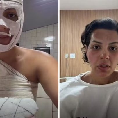 Nutricionista sofre queimaduras de 33% do corpo após explosão de saco de lixo