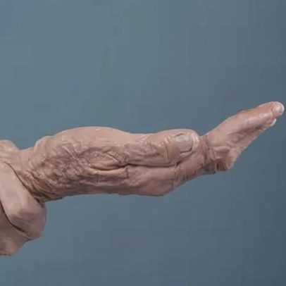 Quando considerar a cirurgia no tratamento da doença de Parkinson
