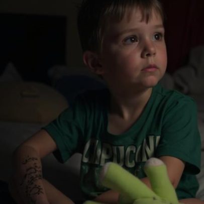 Menino de 5 anos fica com cicatriz após reação alérgica a henna