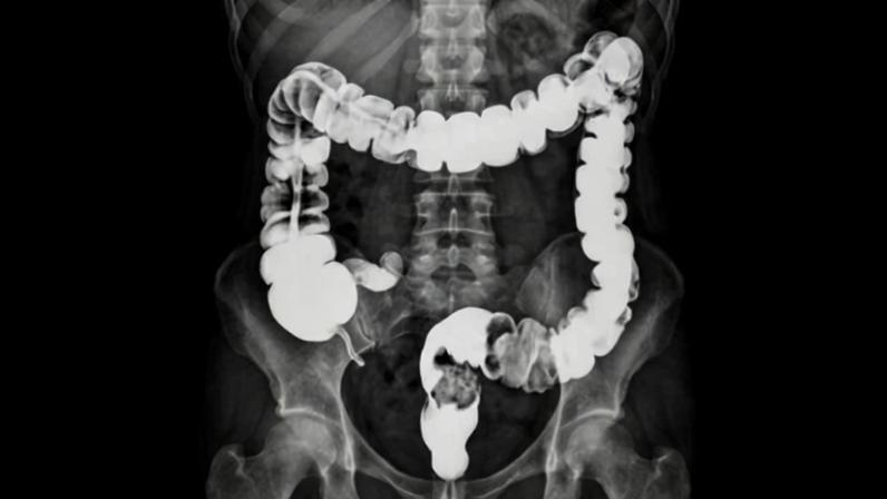 Na imagem, produzida com ajuda de inteligência artificial, o raio-X da região onde fica o intestino