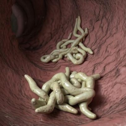 Gastroenterologista aponta sinais que indicam vermes no intestino