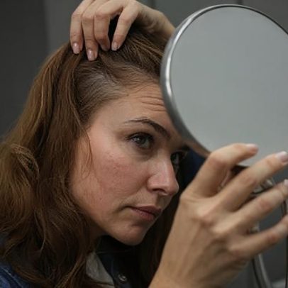 Transplante capilar sem raspar o cabelo ganha alta procura entre mulheres
