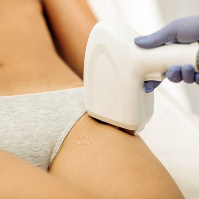 Depilação íntima com laser: entenda como funciona e se dói