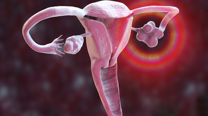 Ilustração 3D do sistema reprodutor feminino em tons de rosa e roxo, com um ovário à direita emitindo um brilho vermelho e laranja, indicando dor ou inflamação