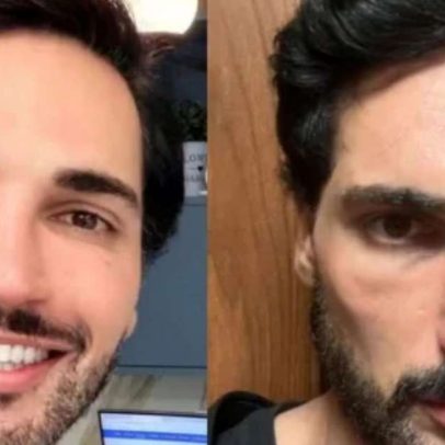 Influenciador revela efeito de caneta emagrecedora no rosto