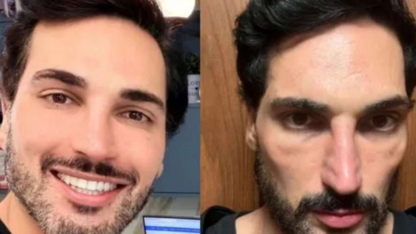O dano colateral do Mounjaro é provocado pelo emagrecimento rápido, mas um especialista aponta que há formas de revertê-lo e até preveni-lo