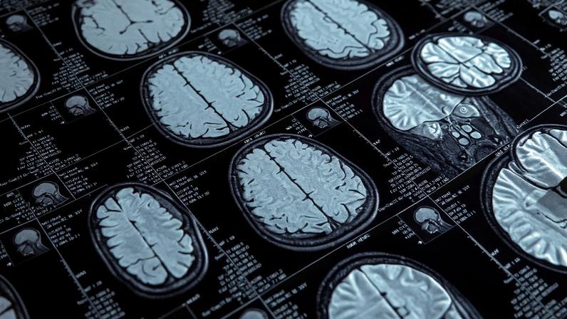 Exames de imagem, como ressonância magnética e tomografia computadorizada, são utilizados no diagnóstico da doença de Alzheimer