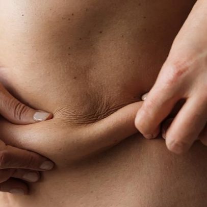 Tecnologia melhora retração da pele após lipoaspiração