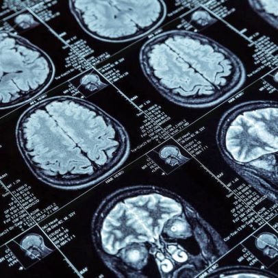 Revisão aponta que remédios para Alzheimer não trazem benefício clínico