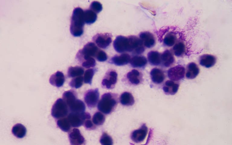 Células de câncer em crescimento anormal
