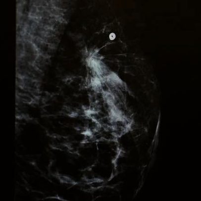 IA usa mamografia para avaliar risco cardíaco em mulheres
