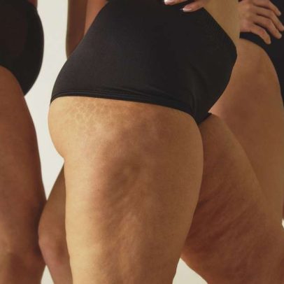 Lipedema ou celulite: como distinguir diferenças e sinais