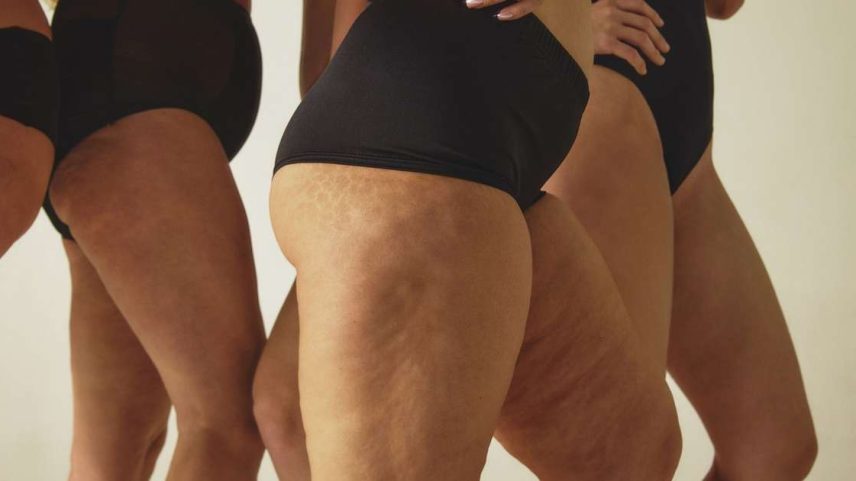 Dor nas pernas e inchaço constante? Descubra a diferença real entre celulite e lipedema e saiba quando esses furinhos exigem cuidados médicos