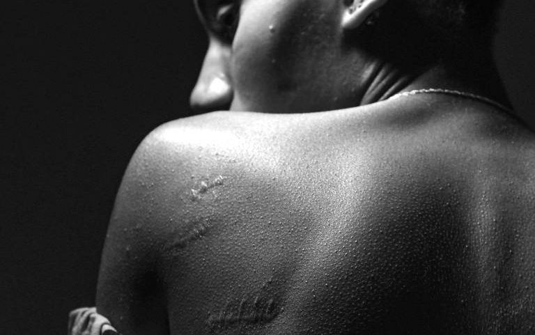 Mulher esfaqueada pelo namorado mostra cicratizes nas costas