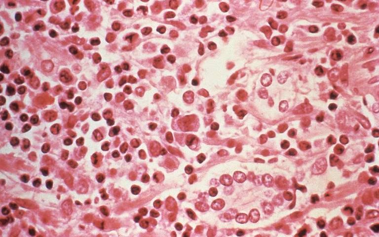 Amostra de tecido hepático extraída de um paciente com síndrome pulmonar por hantavírus