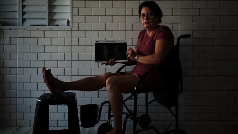 Simone de Castro Antunes exibe raio-X do joelho direito, cujos ligamentos foram rompidos após um acidente de moto - Zanone Fraissat / Folhapress