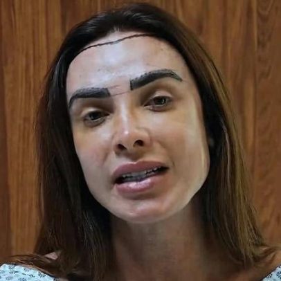 Nicole Bahls faz transplante capilar e afirma estar mais feliz