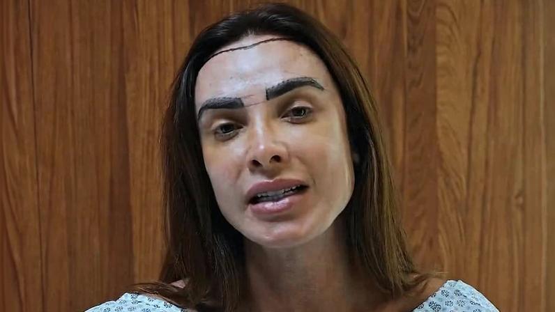 Nicole Bahls explica transplante capilar