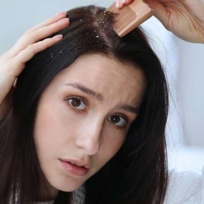 Caspa em adolescentes: por que aparece mais nessa fase da vida