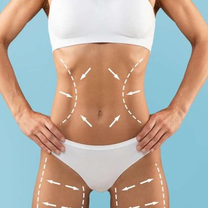 Avanços tecnológicos elevam resultados da lipoaspiração