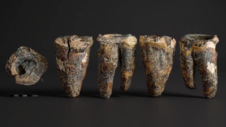 Dente fóssil marrom-escuro com rachaduras e manchas pretas, exibido em cinco ângulos diferentes, incluindo uma vista superior com uma área destacada por um retângulo branco e uma escala de 5 mm