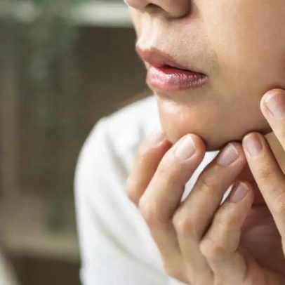 Espinhas no queixo podem indicar acne hormonal, segundo especialistas