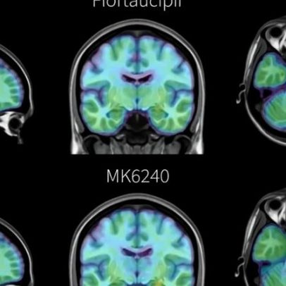 Novo marcador para detectar Alzheimer em estágio inicial