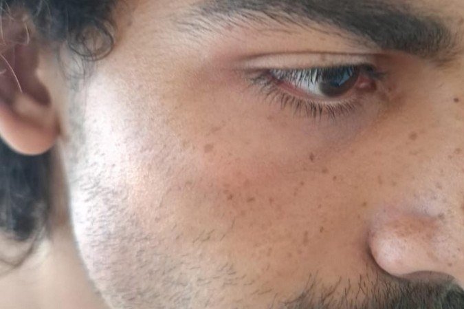 Estudante da UnB mostra rosto inchado após agressão dentro do supermercado Big Box da 408 Norte - (crédito: Arquivo pessoal)