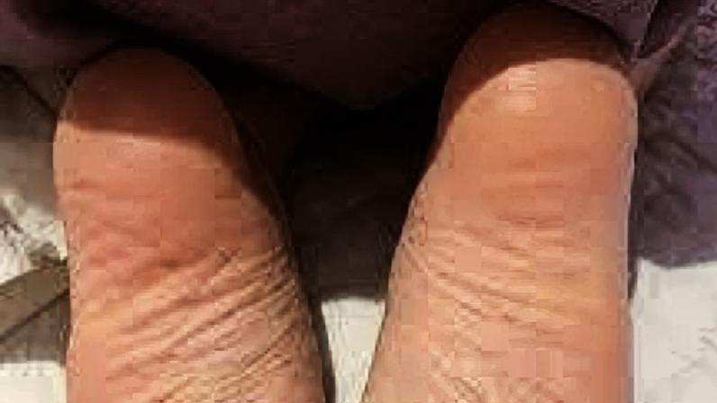 Coceira constante nos pés: causas comuns