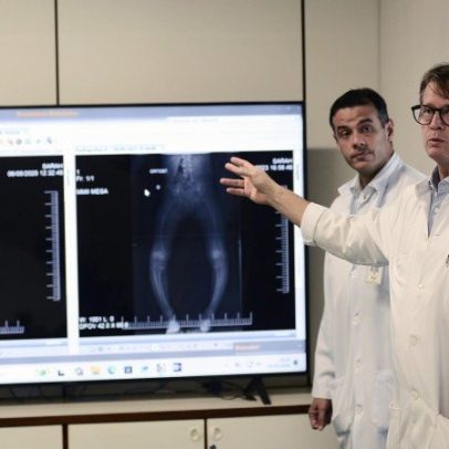 Médicos da Rede Sarah apostam na prevenção para transformar a ortopedia