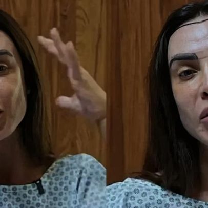 Nicole Bahls faz transplante capilar com técnica discreta e explica decisão