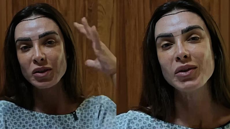 Nicole Bahls faz transplante capilar com técnica discreta e explica decisão - (crédito: Observatorio dos Famosos)