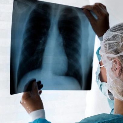 Danos pulmonares surgem cedo em crianças com fibrose cística, aponta estudo