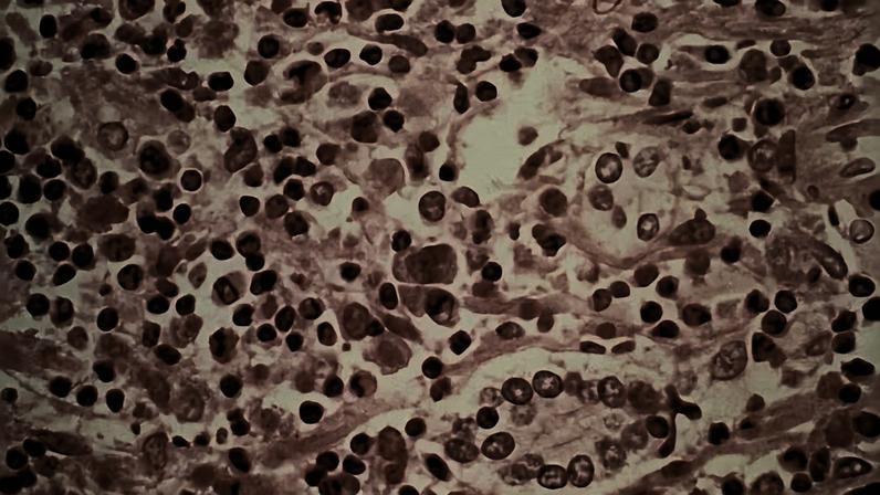 Estudo micrográfico de tecido hepático de um paciente com síndrome pulmonar por hantavírus — Foto: Centros de Controle e Prevenção de Doenças/Divulgação via REUTERS