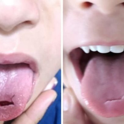 Menino cai em escola em Goiás e corta a língua, gerando preocupação
