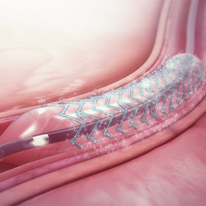 Estudo mundial com stents em diabéticos reafirma eficácia do tratamento atual