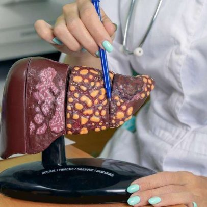 Hepatite silenciosa: como identificar sinais e se prevenir