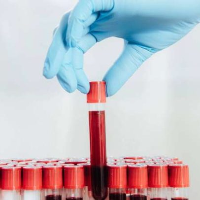 Psiquiatria molecular encontra marcadores da depressão; diagnóstico por sangue é futuro