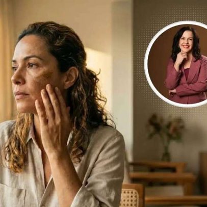 Dermatologista explica fatores que pioram o melasma e como controlá-lo