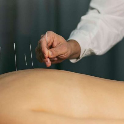 Acupuntura pode ajudar quem quer parar de fumar