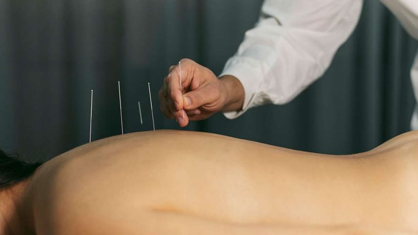 A acupuntura é uma técnica promissora que ajuda a parar de fumar