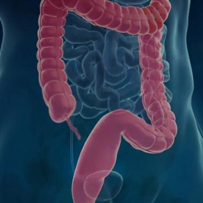 SUS adota teste caseiro de sangue para antecipar câncer colorretal no Brasil