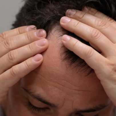 Alimentos que ajudam na prevenção da calvície