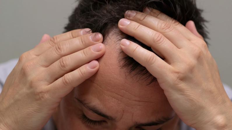 Alimentos que ajudam na prevenção da calvície