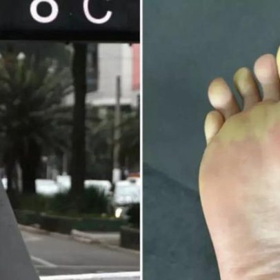 Saí de chinelo no frio; especialista explica o que aconteceu aos dedos