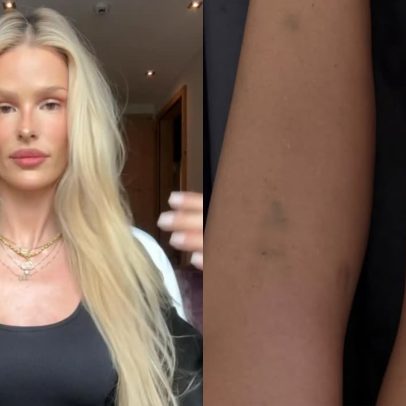 Yasmin Brunet exibe hematomas e comenta lipedema repentino
