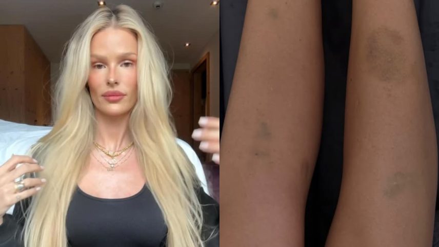Yasmin Brunet mostrou hematomas nas pernas causados pelo lipedema