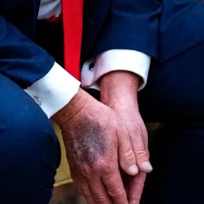 Nova ida de Trump ao médico reacende dúvidas sobre sua saúde
